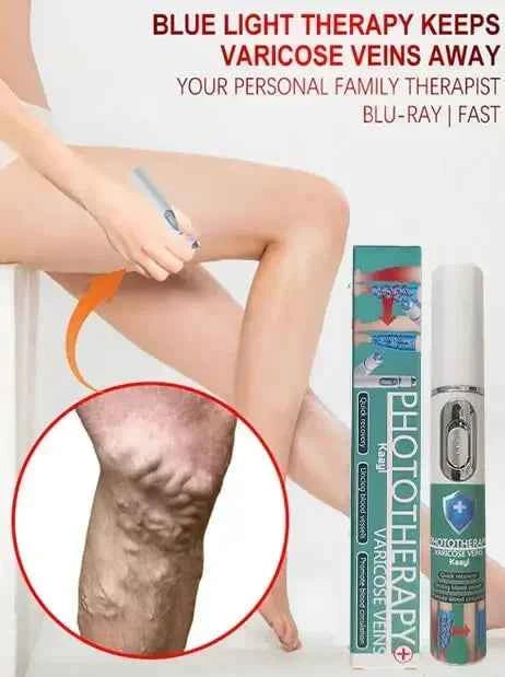 Laser vein | veins hand exercise | cream varicose veins