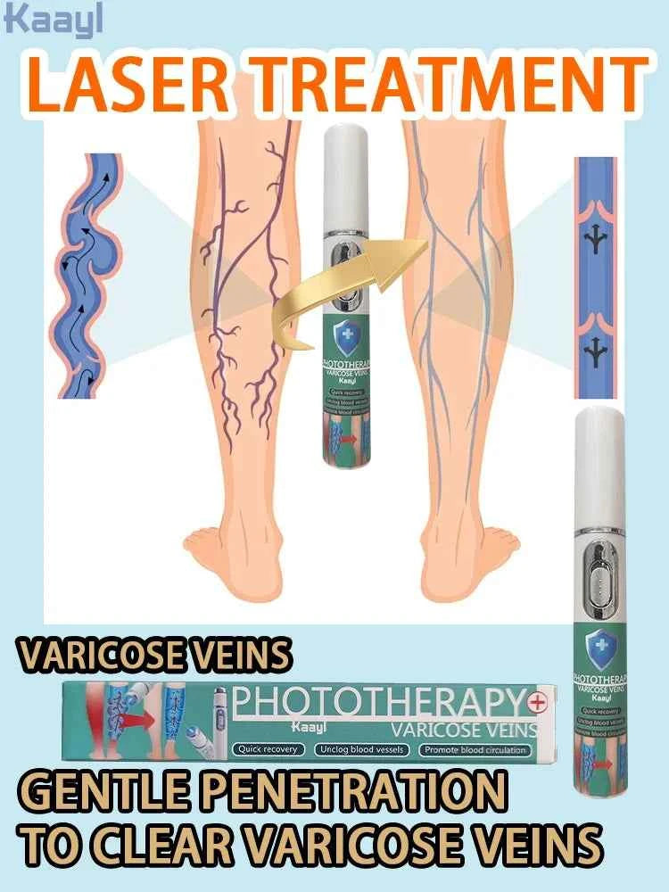 Laser vein | veins hand exercise | cream varicose veins